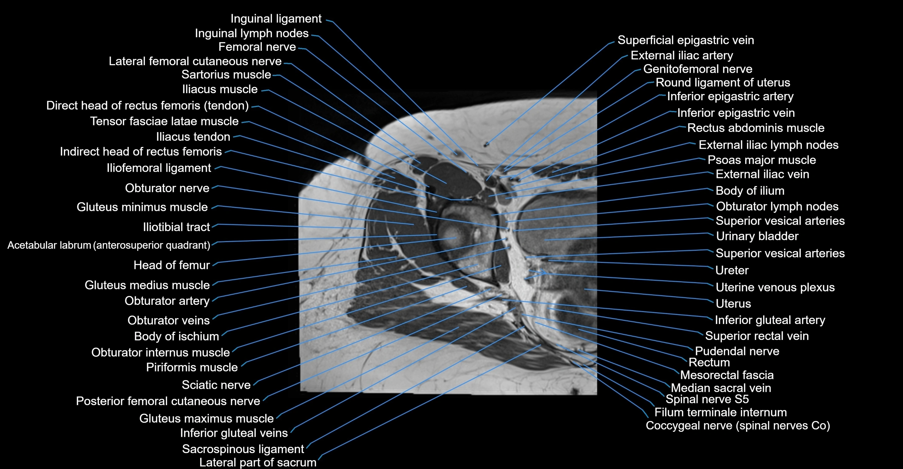 MRI hip axial cross sectional anatomy 3T 3D  radiology  anatomy image-img-00001-00028.webp